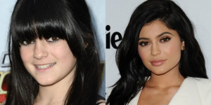 kylie_jenner_plastic_surgery_col.jpg